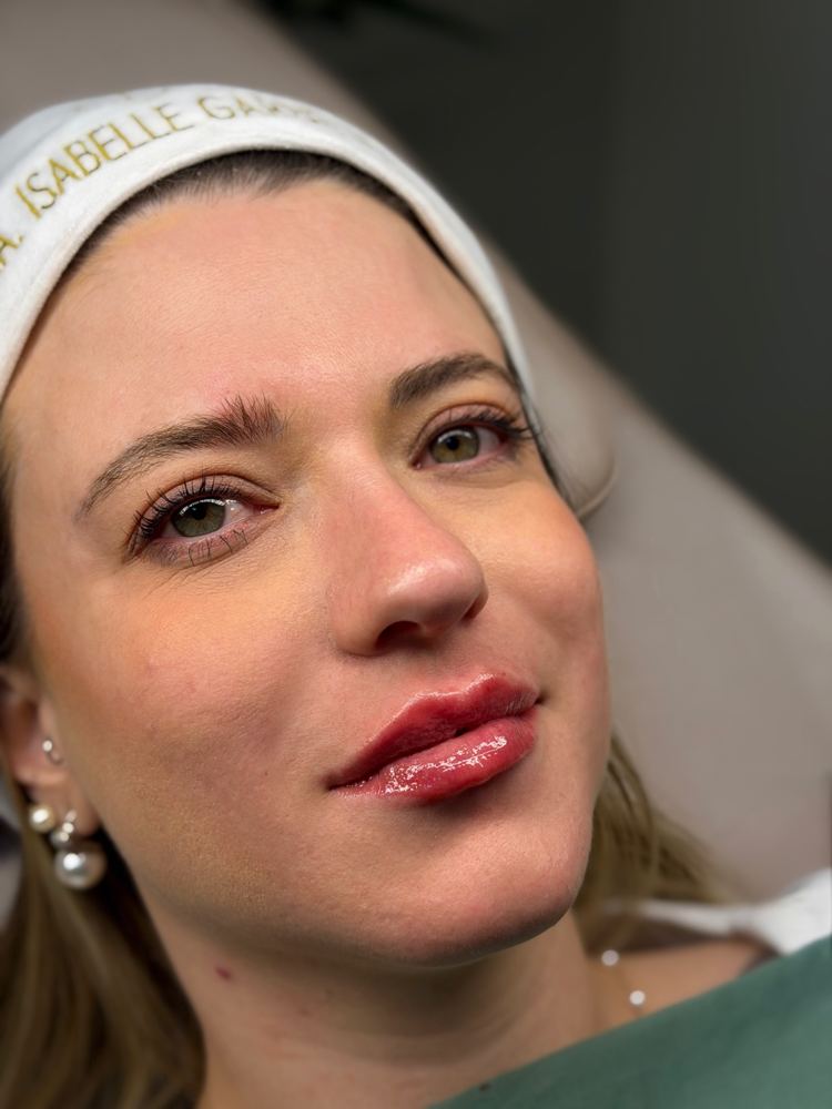 Preenchimento labial, resultado