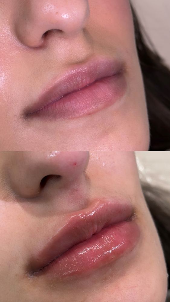 Preenchimento labial, antes e depois